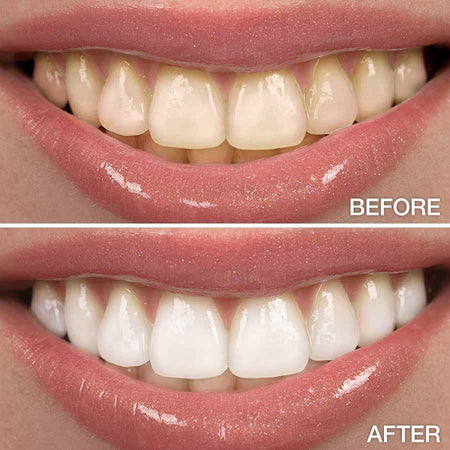 PAP+ Teeth Whitening Strips